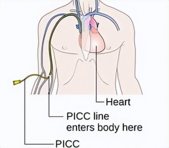 ​picc管 经外周插管的 中心静脉导管(PICC)