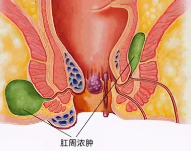 ​肛门疼痛？你该注意了，是否得了肛周脓肿？