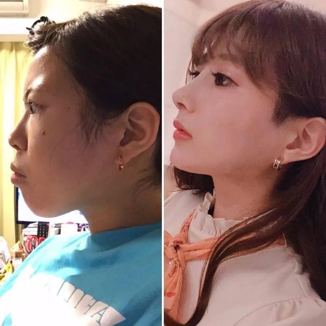 日本年轻女人整容前后对比（日本妹子花700万整成小仙女）(2)