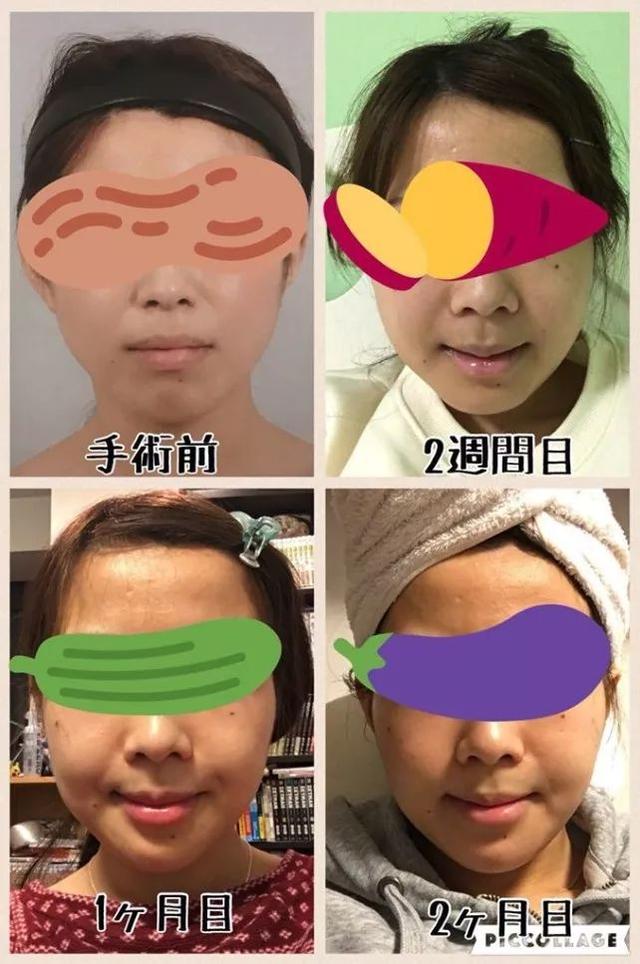 日本年轻女人整容前后对比（日本妹子花700万整成小仙女）(5)