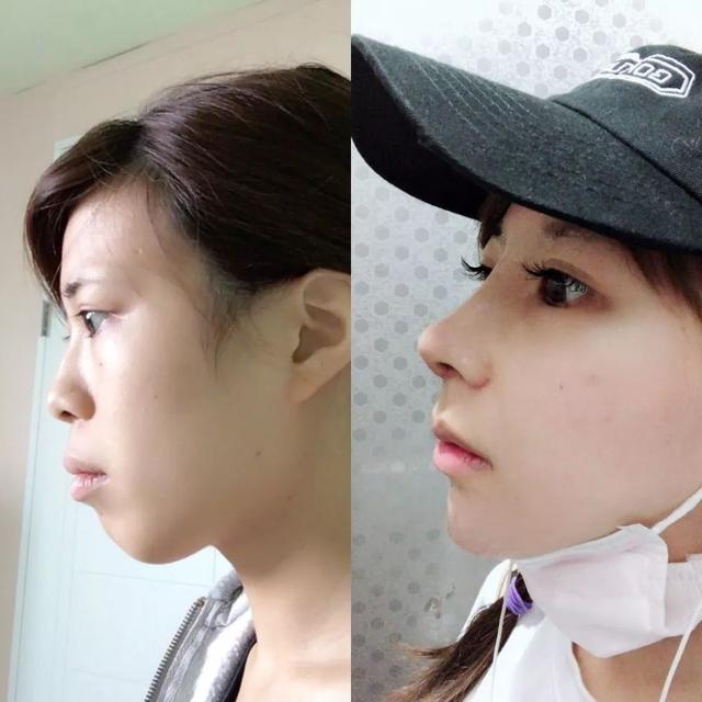 日本年轻女人整容前后对比（日本妹子花700万整成小仙女）(18)