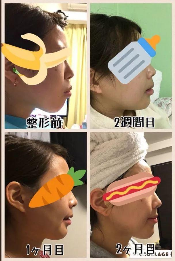 日本年轻女人整容前后对比（日本妹子花700万整成小仙女）(6)