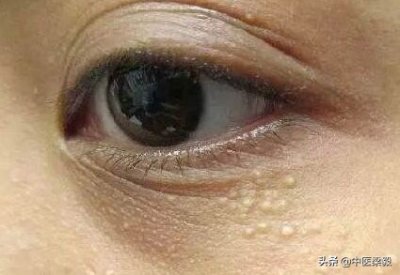 ​比较常见的良性瘤——汗管瘤