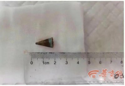 ​西安一男子在气管取出一枚笔帽里 竟是20年前玩耍时吸入的